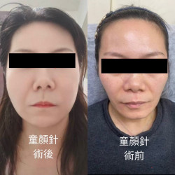  4D童顏針 #童顏針讓你悄悄變美的秘密武器！