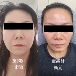  4D童顏針 #童顏針讓你悄悄變美的秘密武器！