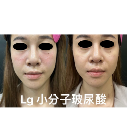 小分子玻尿酸補水療程—讓美麗悄悄升級，水嫩更有感！
