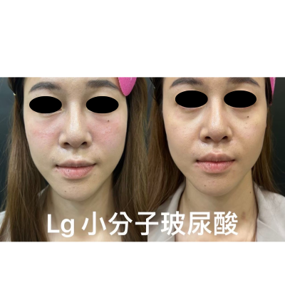 玻尿酸—讓美麗悄悄升級，水嫩更有感！