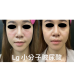 玻尿酸—讓美麗悄悄升級，水嫩更有感！